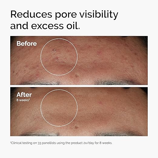 The Ordinary Niacinamide 10% + Zinc 1% Smoothing Serum for Blemish-Prone Skin 30ml